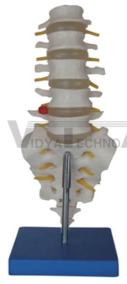 Life-size lumbar vertebrae with sacrum & coccyx and herniated disc